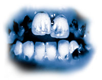 A kristálymetben lévő mérgező összetevők súlyos fogromláshoz vezetnek. A fogak elfeketülnek, foltosak lesznek, és rothadásnak indulnak, gyakran olyan mértékben, hogy ki kell húzni őket. A fogak és az íny belülről romlik, és a fogak gyökere elrothad.
